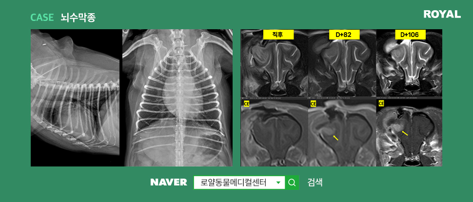 뇌수막종 방사선